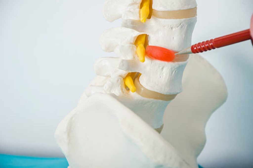 El tratamiento de hernia de disco un procedimiento con más de 90 de efectividad