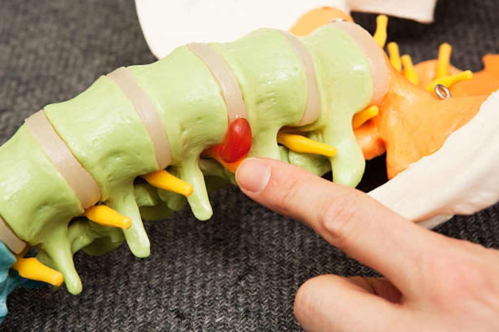 Qué es la hernia de disco y cómo prevenirla