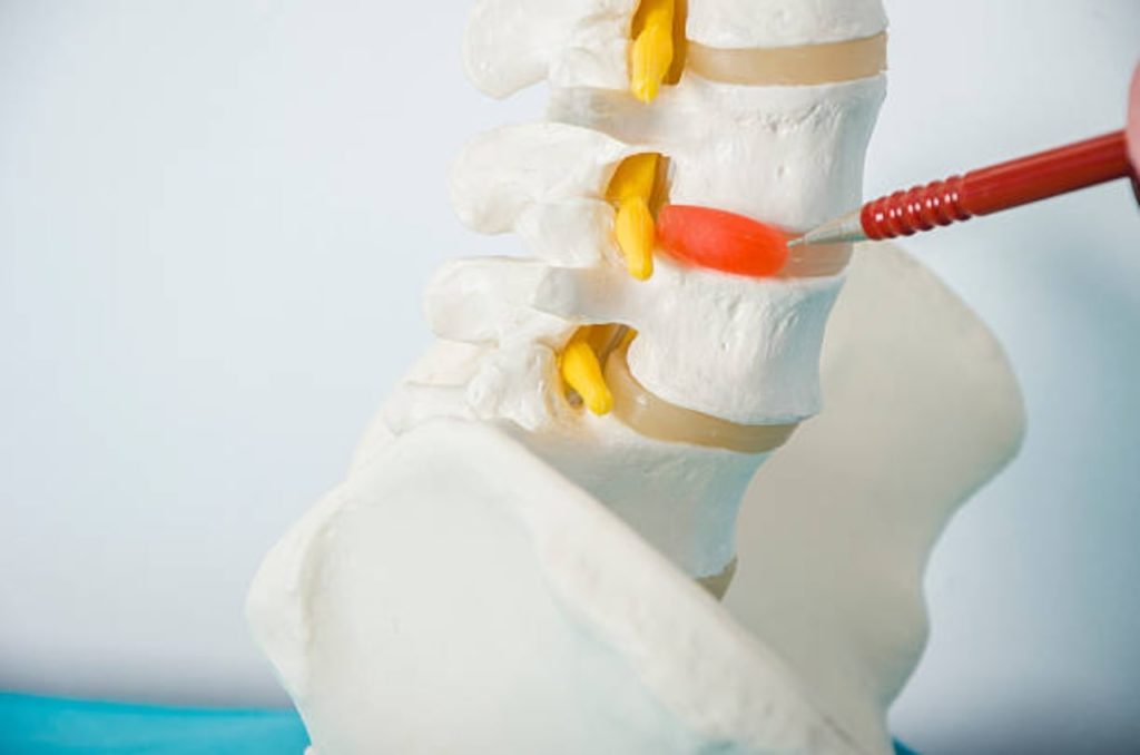 Método conservador como tratamiento para hernia de disco cervical min