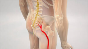 Hernia discal y la ciática: ¿cómo se pueden tratar?