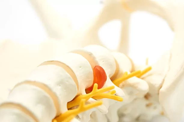 tratamiento para hernia de disco