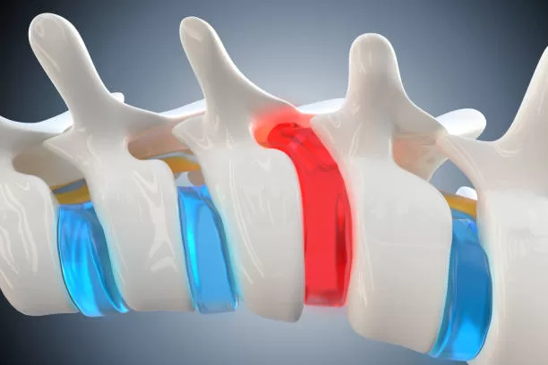 Consejos de especialistas para el alivio del dolor de la hernia discal