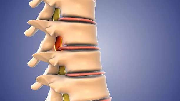 Tratamiento para hernia de disco