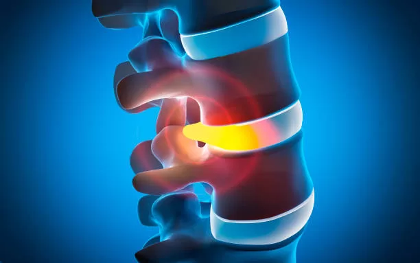 ¿Es necesario operar la hernia discal?