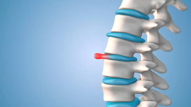 ¿Cuáles son los tratamientos más efectivos para la hernia de disco?