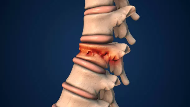 Manejo integral de una hernia discal