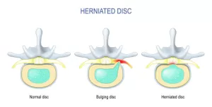 Manejo integral de una hernia discal