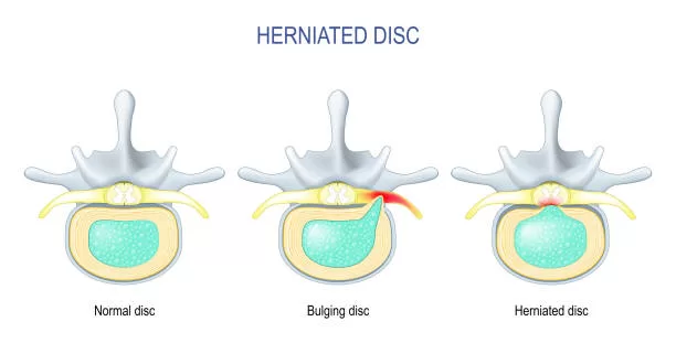 Manejo integral de una hernia discal