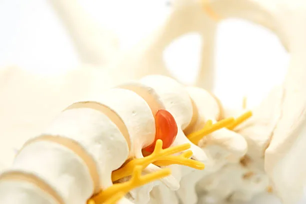 ¿Por qué una hernia discal causa debilidad en las piernas o pies?