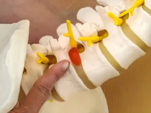 ¿Es posible hacer pesas si tengo una hernia discal?