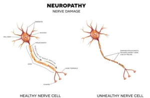 neuropatía diabética tratamiento para el dolor