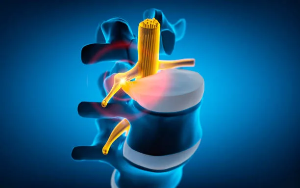 tratamiento para hernia discal
