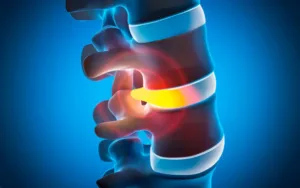tratamiento para hernia discal