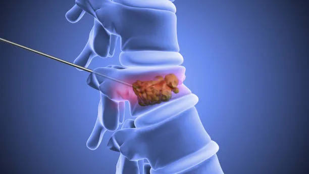 ¿Cómo saber si el tratamiento para la hernia discal está funcionando bien?