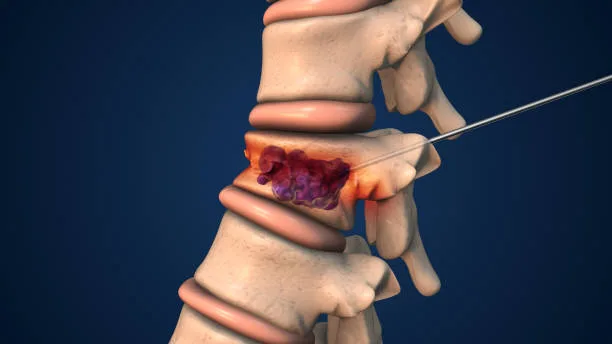¿Cuánto tiempo tarda en hacer efecto un tratamiento para la hernia discal? ¿Cuánto tiempo tarda en hacer efecto un tratamiento para la hernia discal?